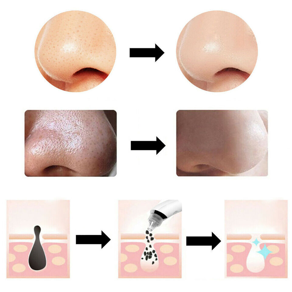 ASPIRATORE FACCIALE RIMOZIONE PUNTI NERI BRUFOLI PULIZIA VISO PORI NASALI XN8030