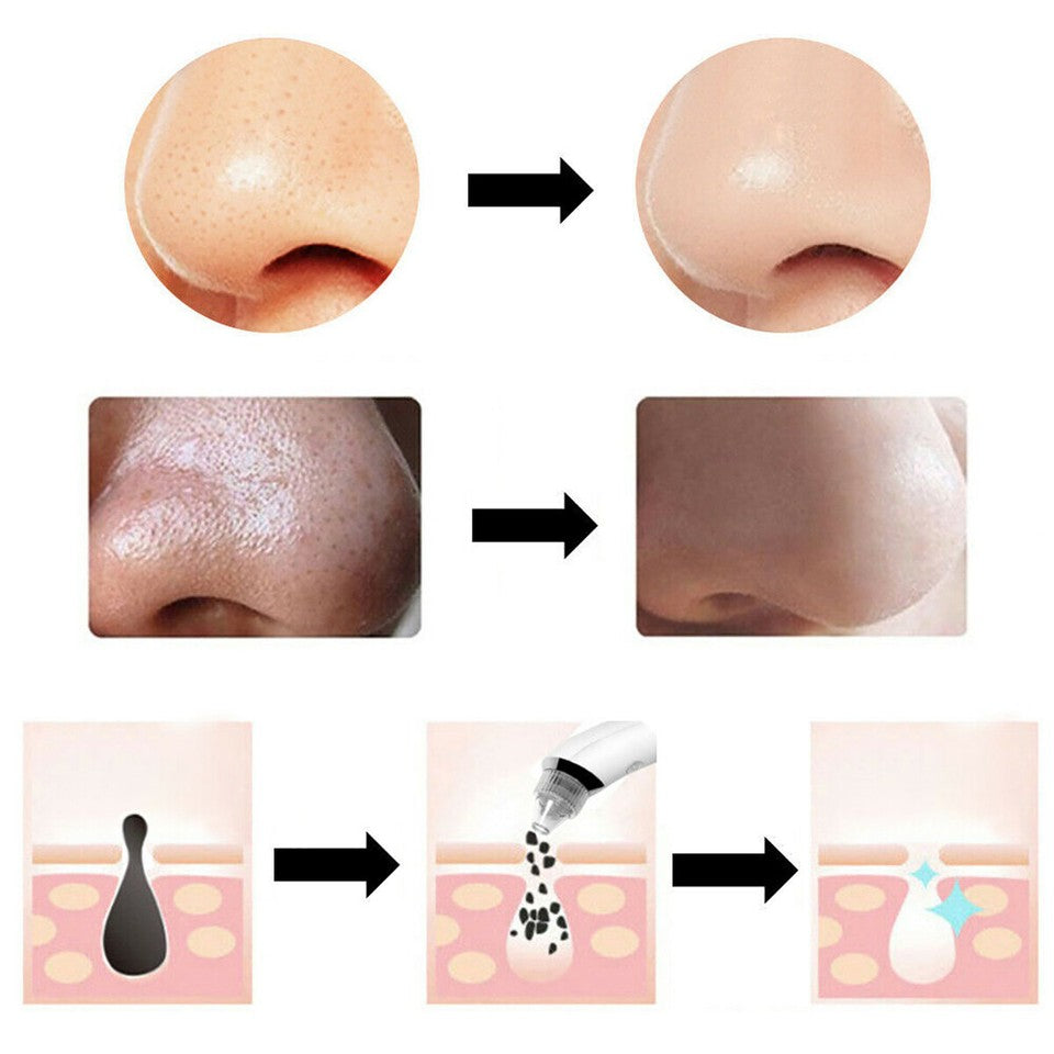 ASPIRATORE FACCIALE RIMOZIONE PUNTI NERI BRUFOLI PULIZIA VISO PORI NASALI XN8030